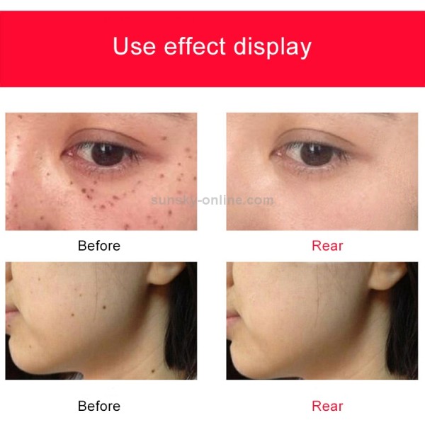 SONGSUN X2 Professional Portable Skin Spot Tattoo Freckle Removal Machine Mole Dot Removing Laser Plasma Beauty Care Pen with LCD Display Screen & 9 Gears Adjustment(Rose Gold)