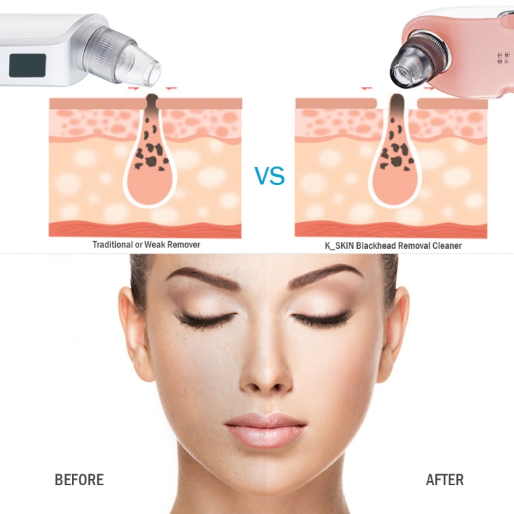 K-SKIN-KD803A-3-Level-Intensity-Blackhead-Removal-Pore-Cleaner-Suction-Rechargeable-Black-Spot-Cleaner-Facial-Cleaning-Machine-SYA001701